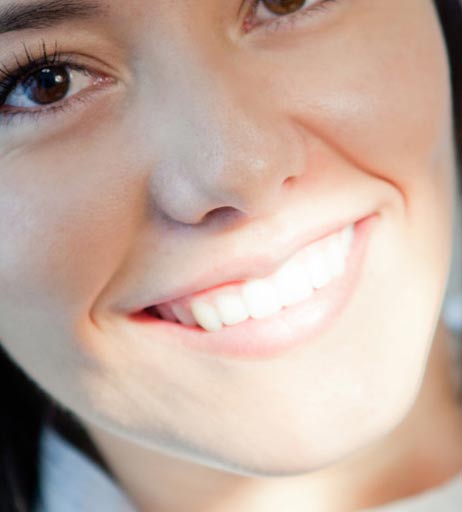 veneers